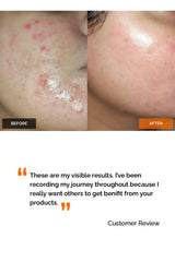 Salicylic Acid 2% Face Serum Simplist