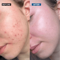 10% Niacinamide Serum - Simplist