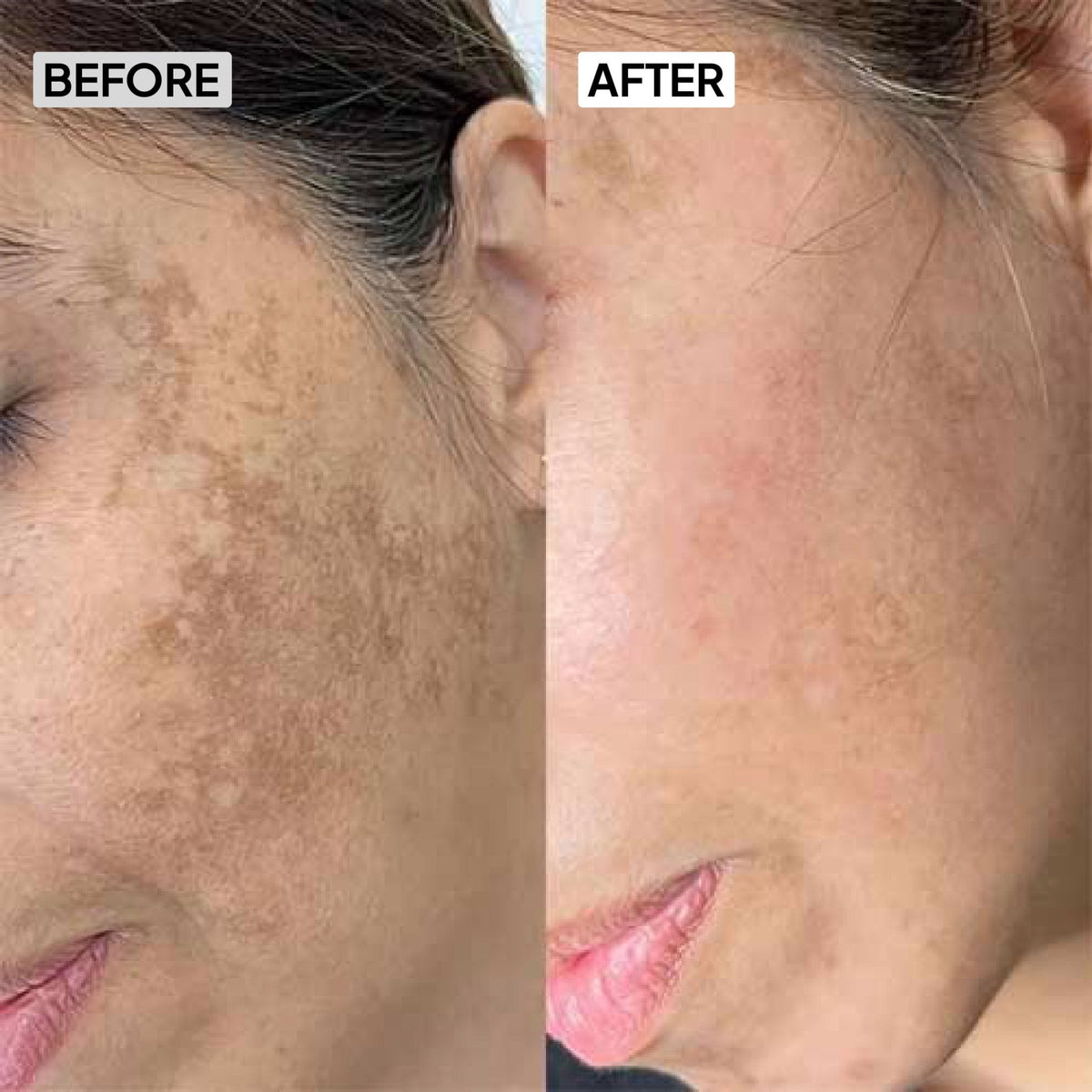 2% Kojic Acid Serum - Simplist