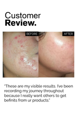 Salicylic Acid Anti Acne Duo