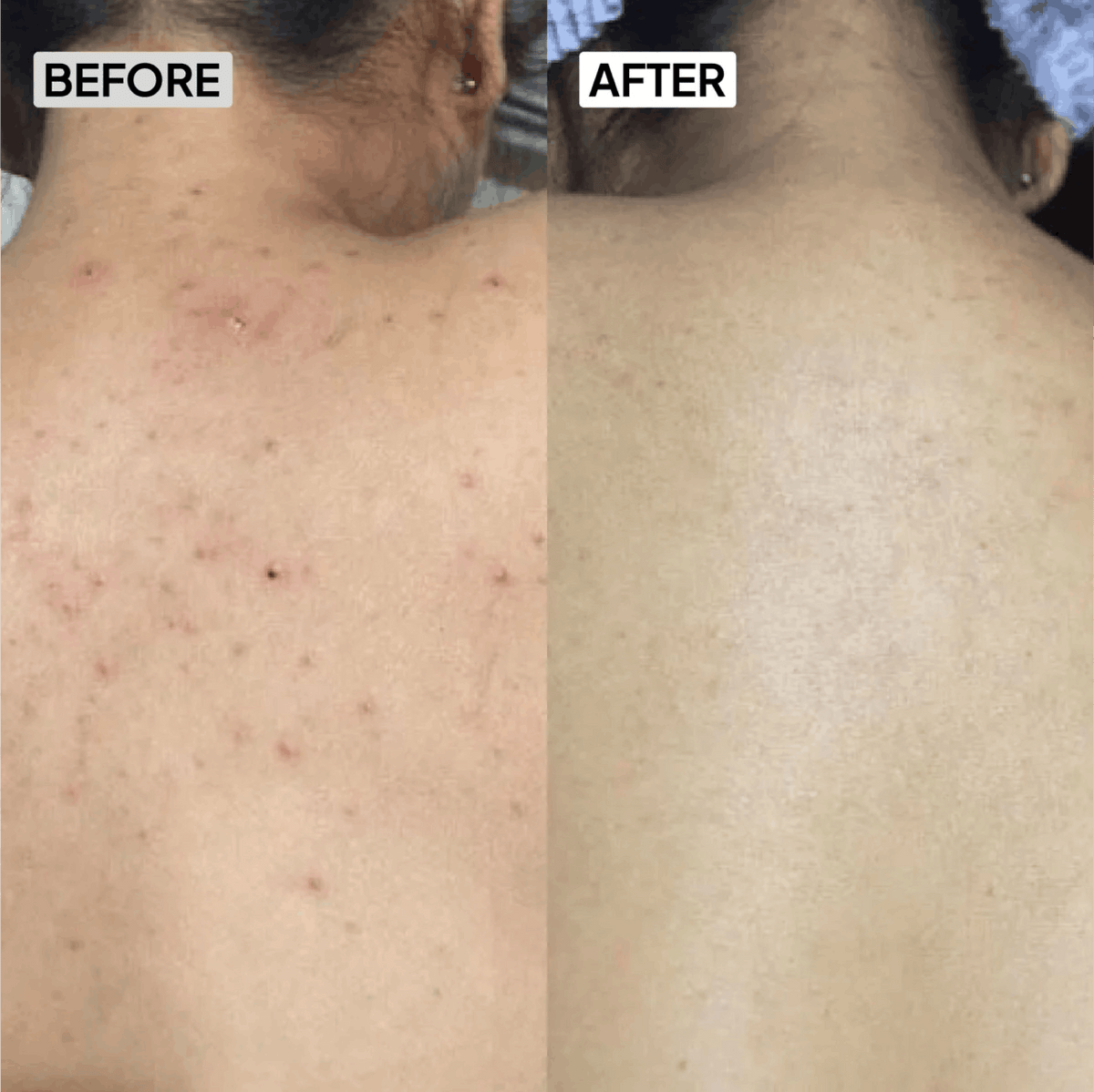 2% Salicylic Acid Body Wash