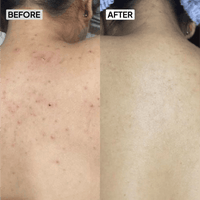 2% Salicylic Acid Body Wash