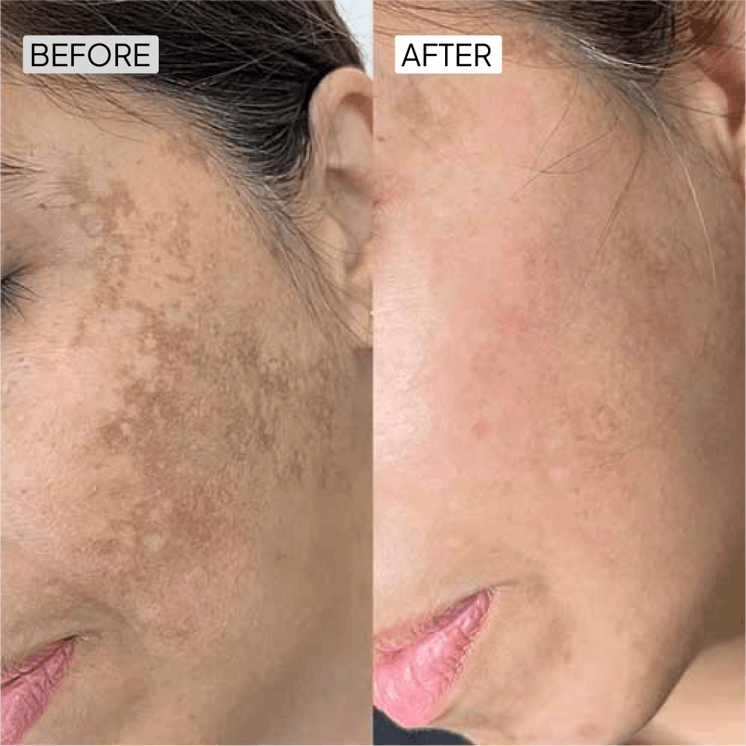 Before After
