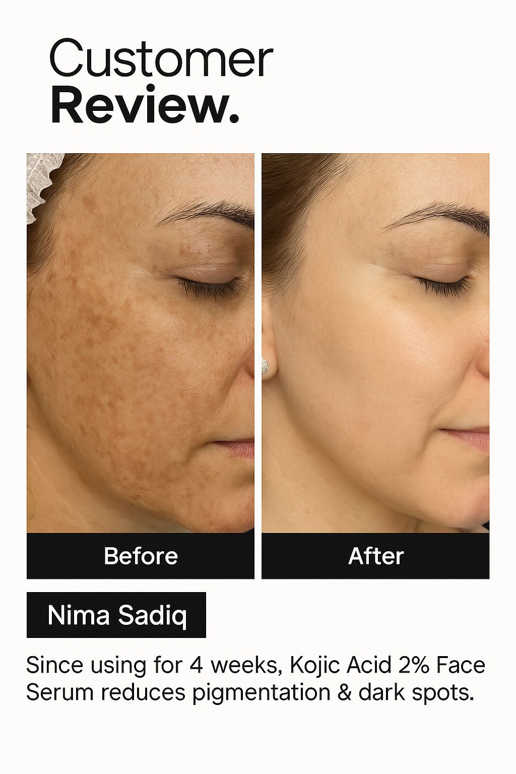 Kojic Acid 02% Face Serum before after