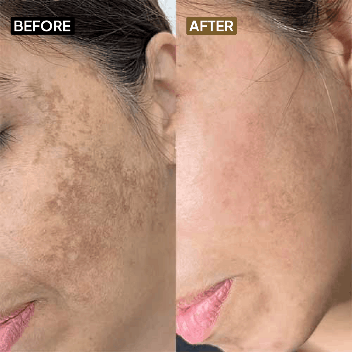 Kojic Acid 2% Face Cream