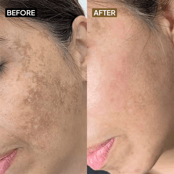 Kojic Acid 2% Face Serum