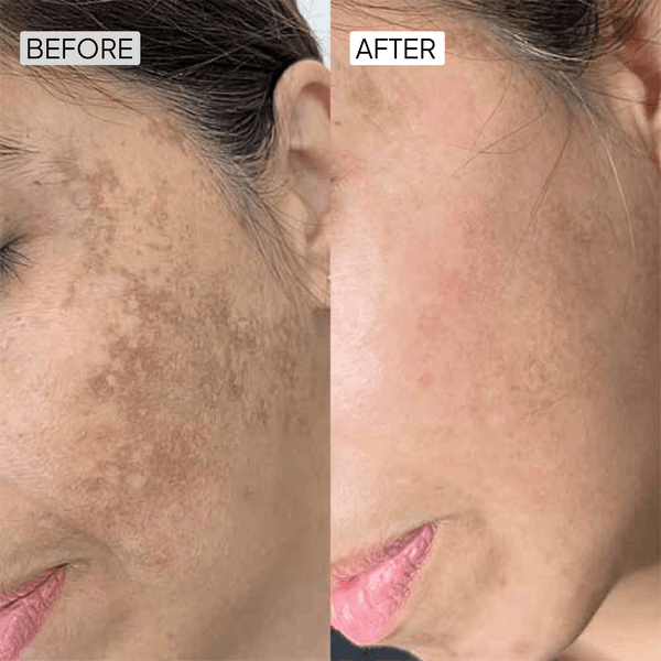 Kojic Acid Anti Pigmentation Kit