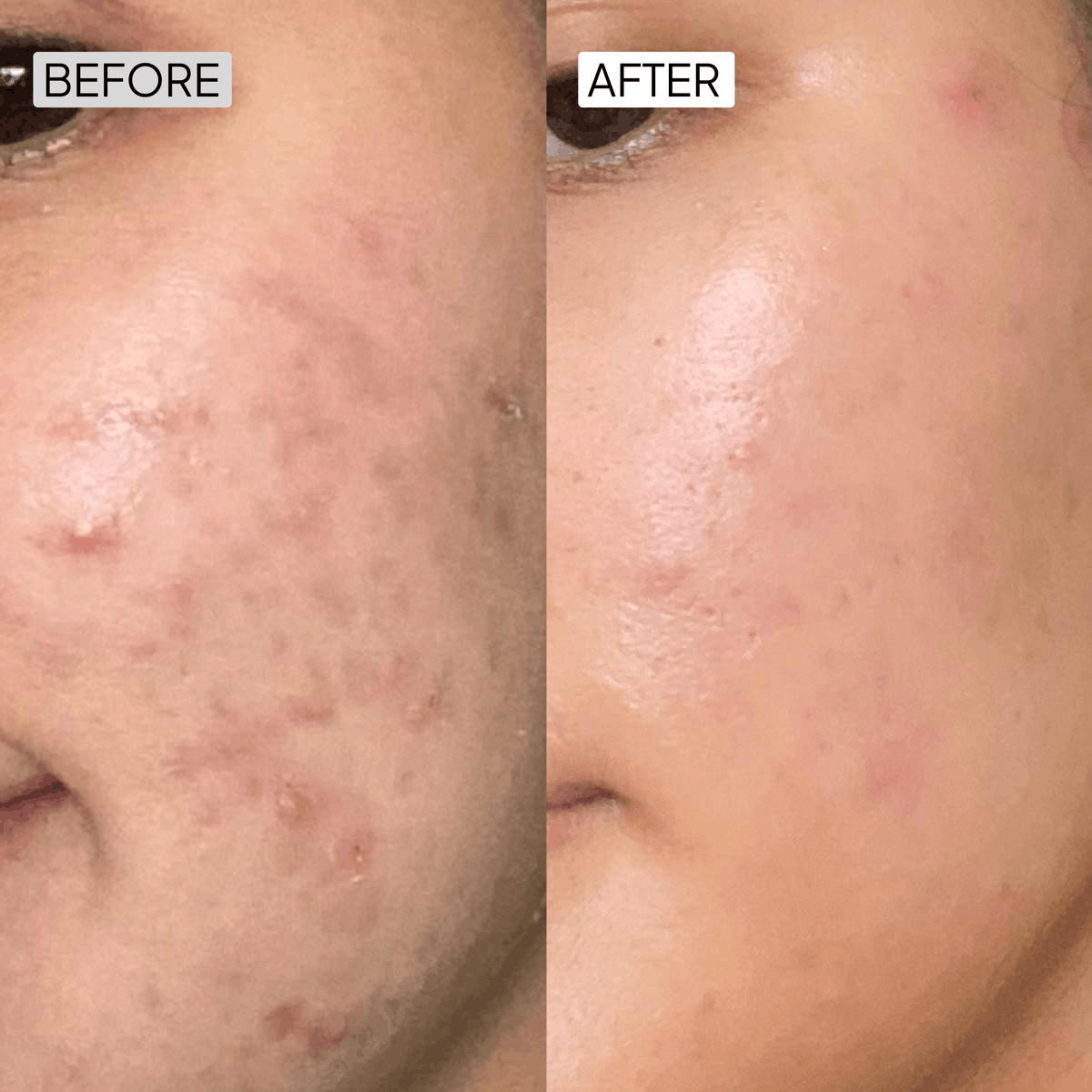 Salicylic Acid Acne Control Kit