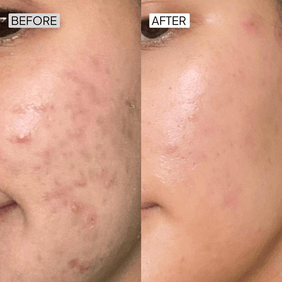 Salicylic Acid Acne Control Kit