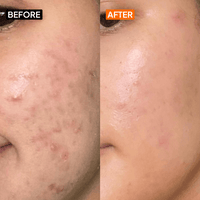Salicylic Acid 2% Gel Cleanser