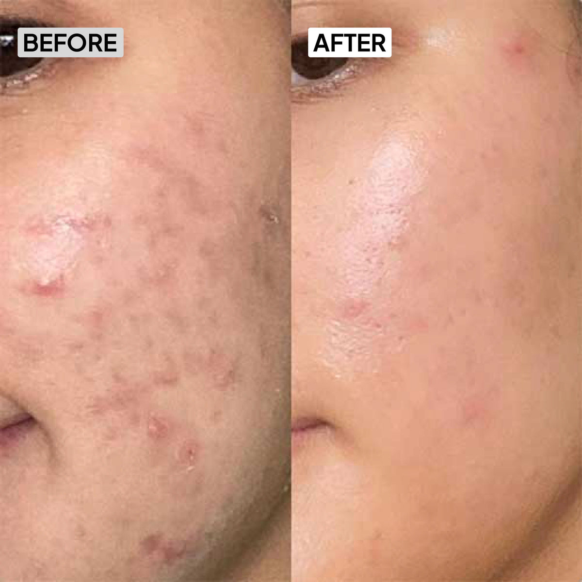 Oily Skincare Kit