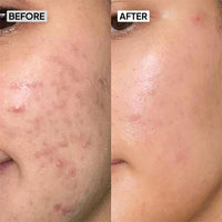 Oily Skincare Kit