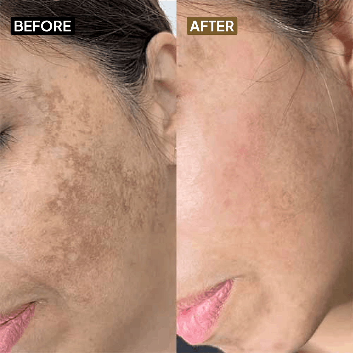 Kojic Acid 2% Face Cream - Simplist
