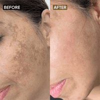 Kojic Acid 2% Face Cream - Simplist