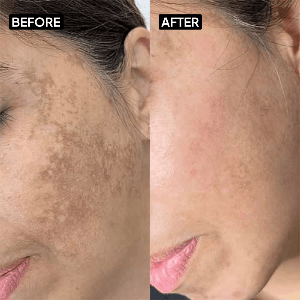 Kojic Acid 2% Gel Cleanser - Simplist