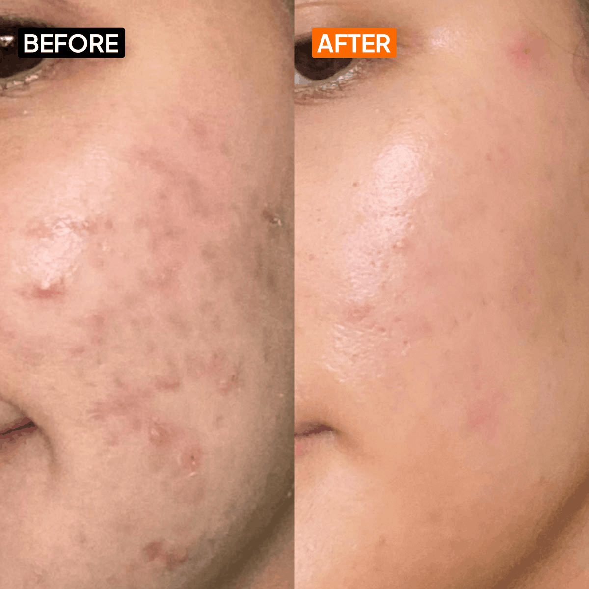 Salicylic Acid 2% Face Wash - Simplist