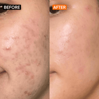 Salicylic Acid 2% Face Wash - Simplist
