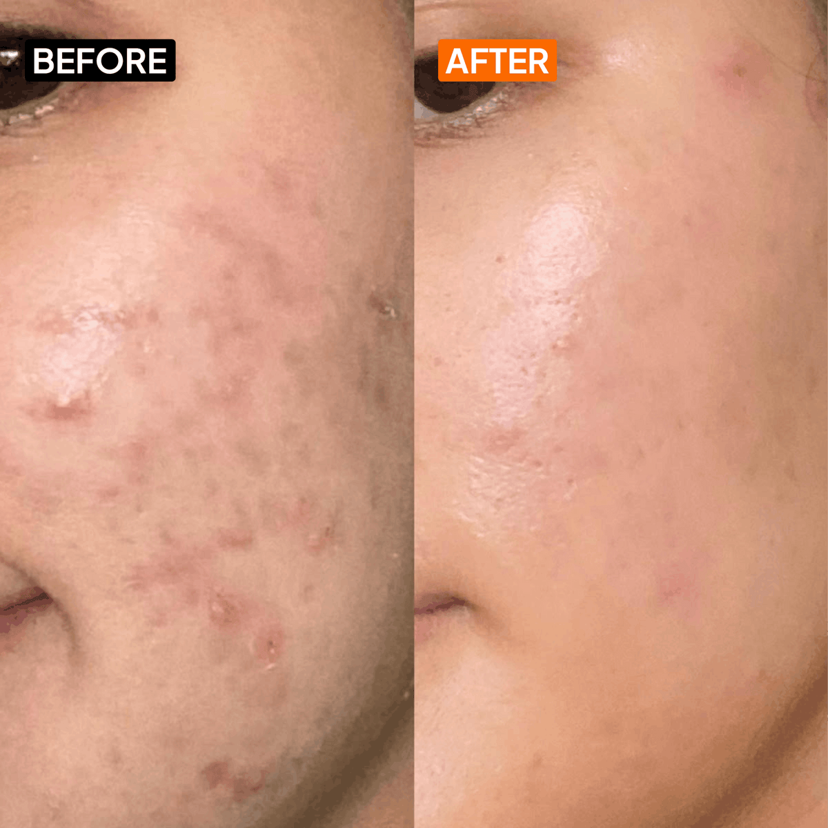 Salicylic Acid 2% Gel Cleanser - Simplist
