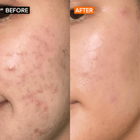 Salicylic Acid 2% Gel Cleanser - Simplist