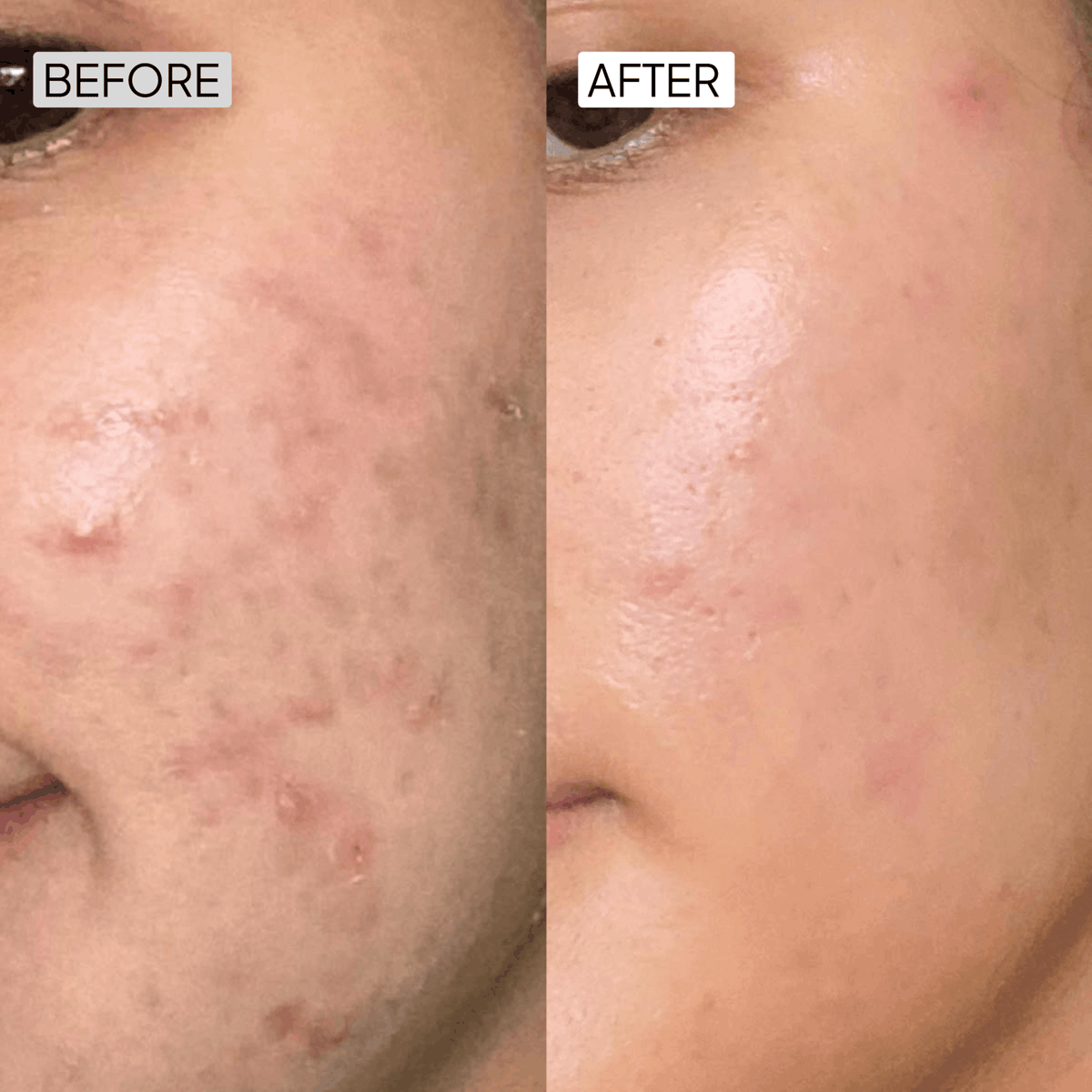 Salicylic Acid Acne Control Combo - Simplist