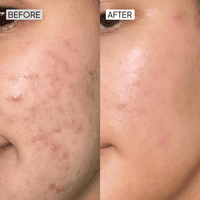 Salicylic Acid Acne Control Kit - Simplist
