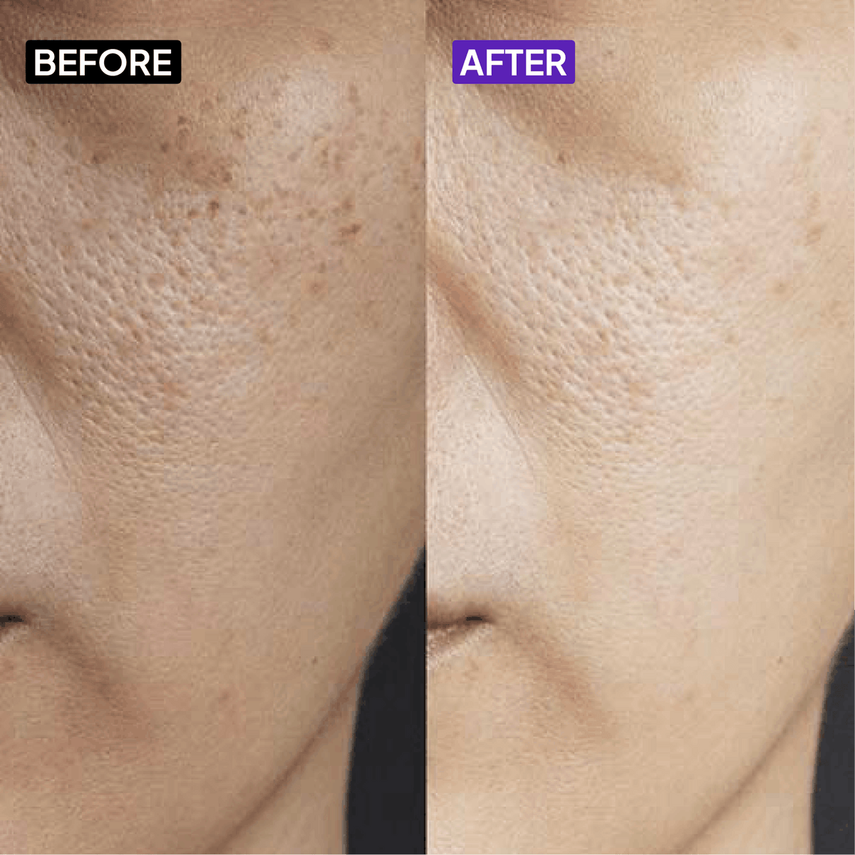 Vitamin B5 10% Moisturizer - Simplist